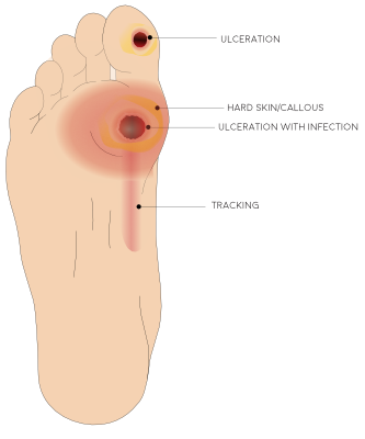 Illustration of the plantar foot displaying an active ulceration with tracking