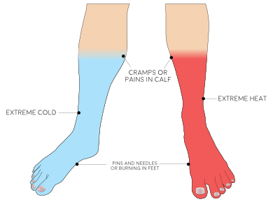 Illustration of two legs displaying hot and cold and sensations to feet from diabetes.