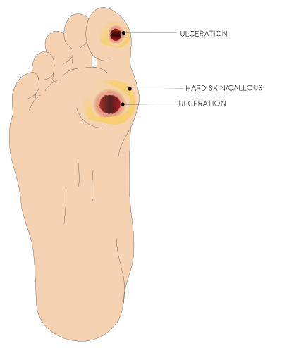 Illustration of plantar foot with an ulceration present