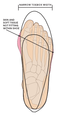 Illustration of poor footwear not accommodating a foot 