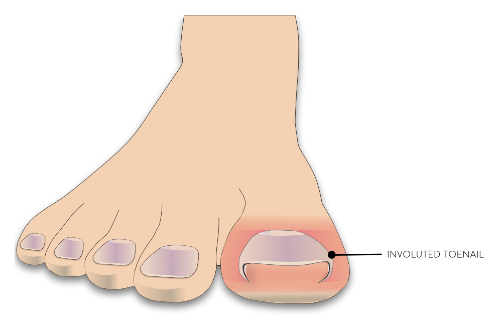Illustration of the foot from the front displaying the look of an involuted toenail