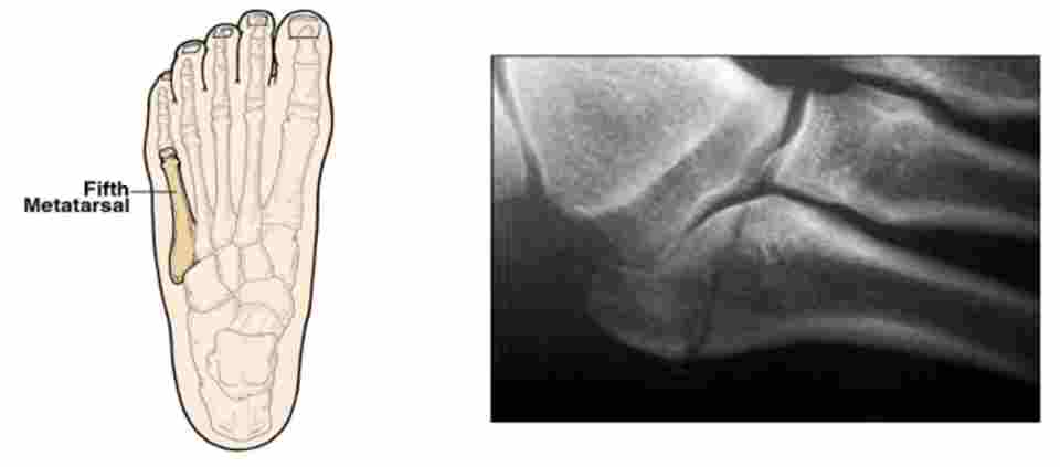 5th Metatarsal fracture shown in an X-Ray