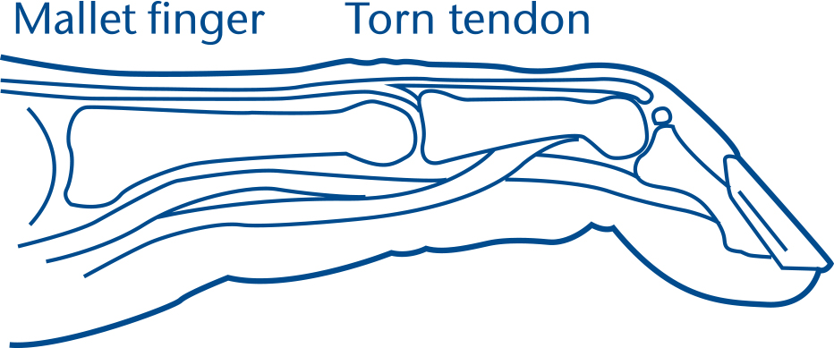 Illustration of mallet finger, and a torn tendon in the finger.