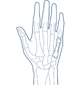 Metacarpal fracture on the 5th finger shown in the X-Ray of a hand
