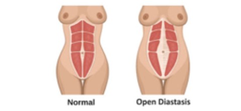 Diagram showing the comparison of normal abdominal muscles to open diastasis