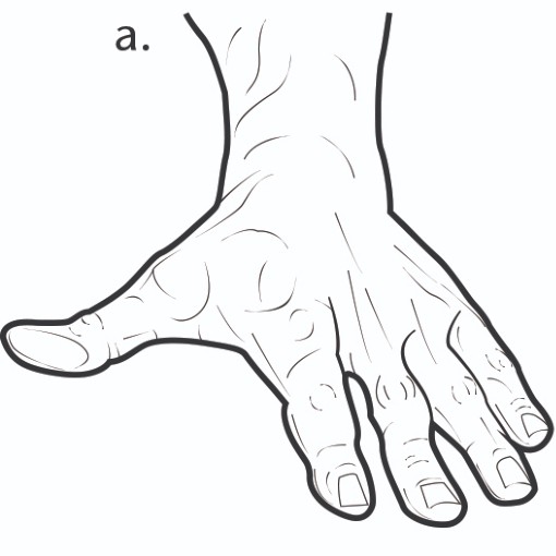 Exercise for finger after an injury