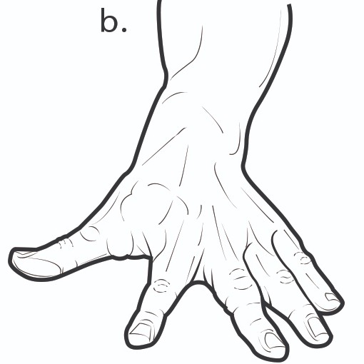 Exercise for finger after an injury