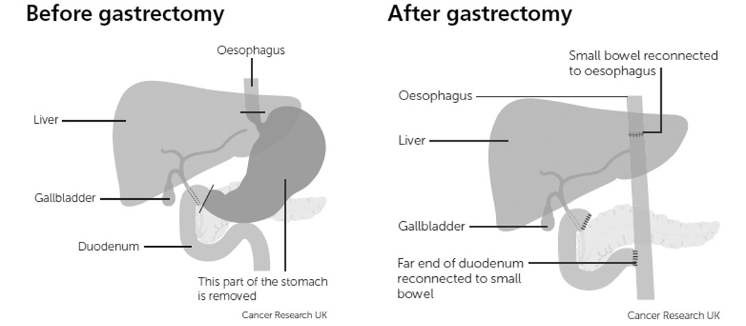 Diagram showing the liver and gallbladder before and after a total gasrectomy