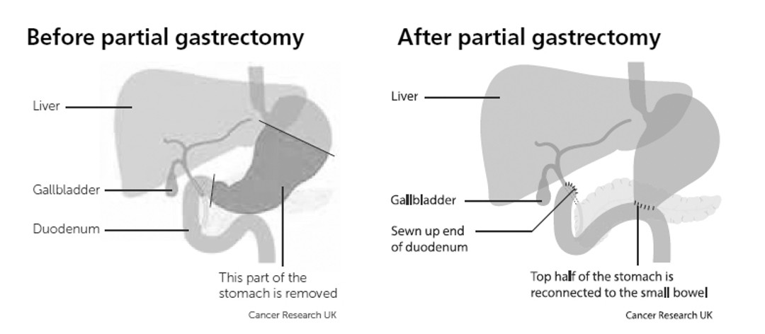 Diagram showing the liver and gallbladder before and after a partial gasrectomy