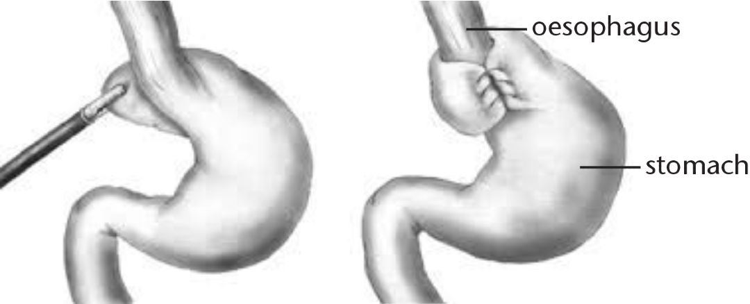 Diagram of Nissen Fundoplication in the stomach