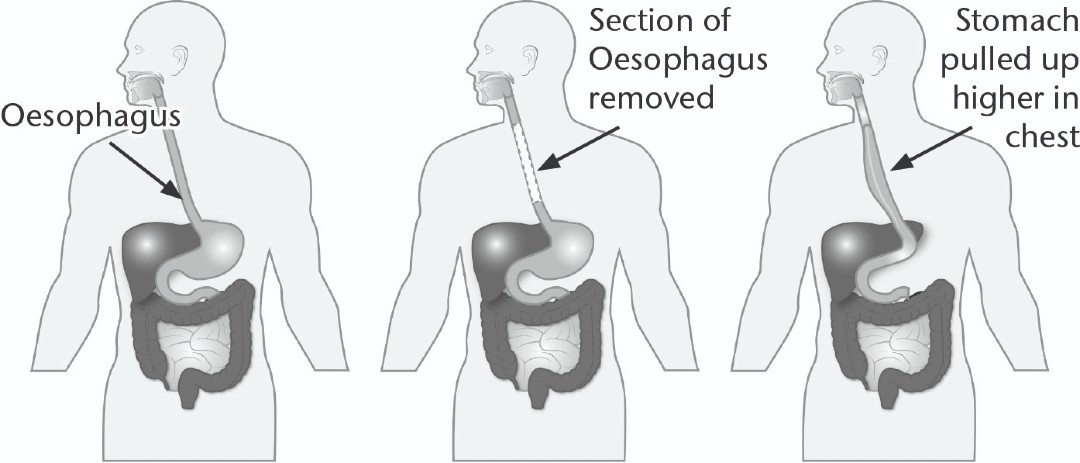 Diagram of how the oesophagus before and after an Oesophagectomy
