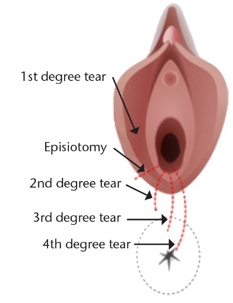 Labelled diagram showing the different types of perineal trauma