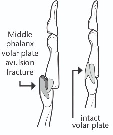 Diagram of the volar plate injury