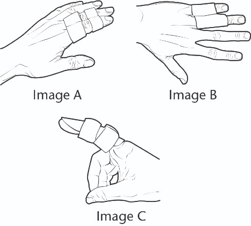 Diagrams of treatment techniques for volar plate injury