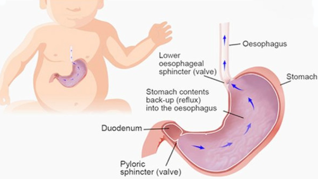 Diagram of the reflux process in the organs of a baby