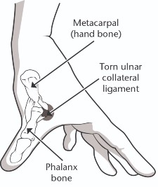 Diagram showing a metacarpal (hand bone, and phalanx bone with a torn ulnar collateral ligament.