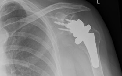Patients Home Same Day After Orthopaedic Surgery