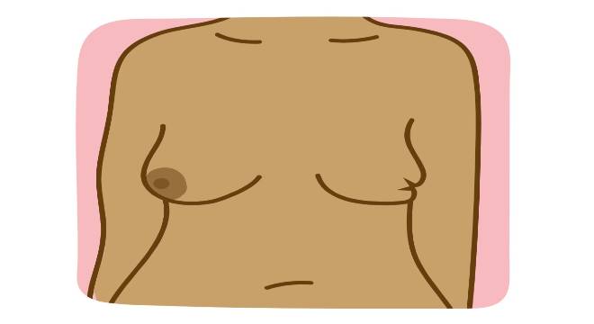 inverted nipple<br />
