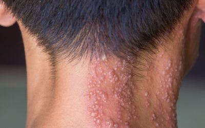 Shingles Vaccination Programme
