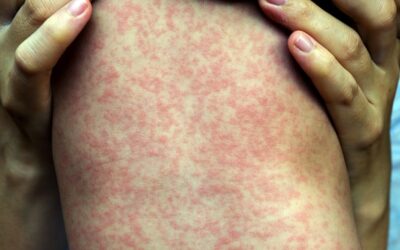 MMR Vaccination